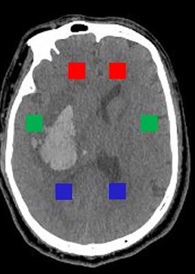 Evaluation of Intracranial Hypertension in Patients With Hypertensive Intracerebral Hemorrhage Using Texture Analysis